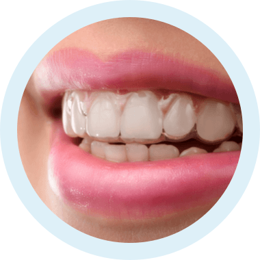 img invisalign anwendung step 3